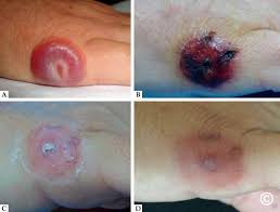 Image result for Nodular Lymphangitis