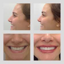 First time Botox and Lip Filler for this beautiful patient by LifeMed  injector @beautynbotox.rn A minimal amount of Botox only 6 units