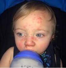 Double stranded linear enveloped replicates in the nucleus. Toddler Struck Down With Herpes Virus That Left Him Screaming In Pain With Red Rash Because Of A Kiss
