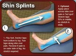 Posterior Shin Splints Taping Google Search Shin Splints Shin Splints Treatment Shin Splints Taping