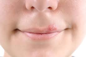 Vielleicht habt ihr schon mal herpes bei jemandem gesehen, vielleicht habt ihr selbst schon unter herpes gelitten. Herpesblaschen An Lippen Oder Nase