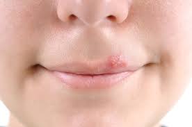 Das problem hierbei ist natürlich, dass ich mich gar nicht wohlgefühlt habe und ich natürlich. Herpesblaschen An Lippen Oder Nase