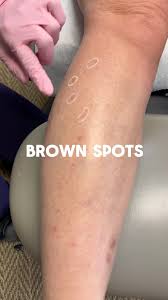 Image result for liver spots on legs