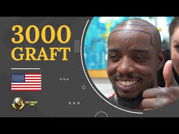 Mr. Michael from #USA prefers Aslı Tarcan for #HairTransplantation