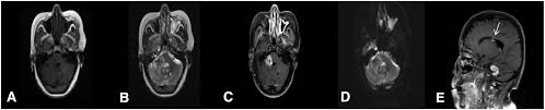 .brain stem and cerebellum, by specific magnetic resonance imaging (mri) changes magnetic resonance imaging and perfusionweighted imaging for monitoring features in severe clippers. Chronic Lymphocytic Inflammation With Pontine Perivascular Enhancement Responsive To Steroids Clippers A Lymphocytic Reactive Response Of The Central Nervous System A Case Report Journal Of Neuroimmunology