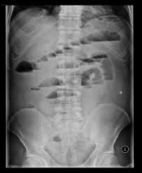 Large Bowel Obstruction Due To Colorectal Carcinoma In The Descending Colon Radiology Case Radiopaedia Org Bowel Obstruction Radiology Large Bowel