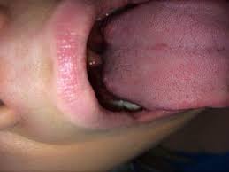 Zunge Roter Fleck Denta Beaute