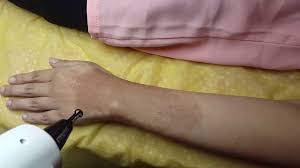 Maybe you would like to learn more about one of these? Laser Tanda Lahir By Indah Wulansari