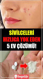 Ev Yapimi 5 Dogal Sivilce Cozumu Sosyolife Net Dogal Akne Tedavisi Ev Yapimi Cilt Bakimi Akne Tedavisi