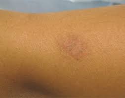 Image result for Eczema nummulare