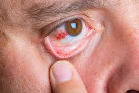 Image result for Scleritis