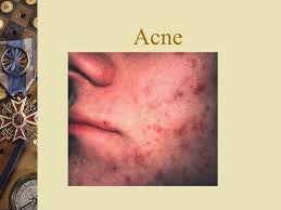 Pediatric Skin Disorders Ppt Video Online Download