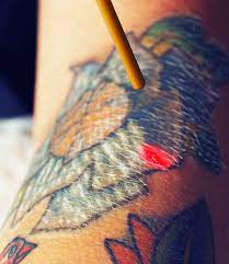 The greatest benefit is the peace of mind that comes from the removal of the unwanted tattoo. Tattoo Removal Before After Photos Tattoo Removal Patient Results