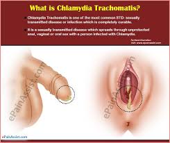 Chlamydia is a sexually transmitted infection/disease that affects both men and women. Chlamydia Trachomatis Causes Symptoms Treatment How Does It Spread Prevention