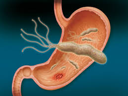 Helicobacter Pylori