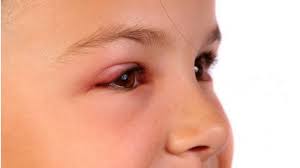 Ulciorul este o afecțiune des întâlnită, deopotrivă la copii și la adulți. Urcior La Ochi Ce Este Complet Interzis SÄ Faci Exquis