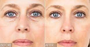 Eye bags atau dalam bahasa ibunda kita lingkaran hitam bawah mata. Petua Semulajadi Hilangkan Eye Bag Dan Mata Panda 11 Cara Hilangkan Eye Bag Secara Semulajadi Dalam 30 Minit