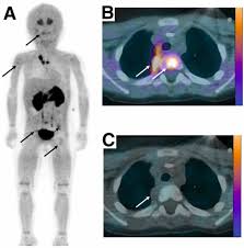 Nuclear medicine techniques in paediatric body oncology: Present and future  - EJC Paediatric Oncology