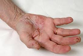 Image result for dyshidrosis
