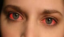 Http Www Lightskincure Org Eye How To Make Your Eyes Red Bloodshot Fast Photoshop Red Eyes Remedy Get Rid Of Tan Eye Health