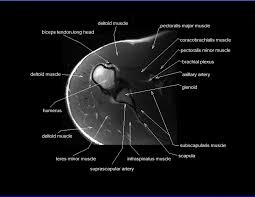 Which are the shoulder muscles and where they are located? Shoulder Anatomy Mri Shoulder Axial Anatomy Free Cross Sectional Anatomy