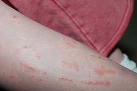 Poison Ivy Oak And Sumac Picture Gallery For Identifying Poison Ivy Remedies Poison Ivy Rash Poison Ivy Plants