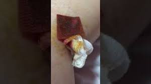 How long to leave the bandage on the wound? Warning This Is Too Painful To Watch Gauze Stuck To Open Wound Youtube