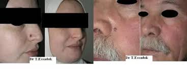 Il n'a pas saigné de sang juste il est apparu une ligne rouge présentant un capillaire et un trou vide.j'ai rien fait meme j'ai pas su qu'est ce que je doit faire.dans mon cas comment dois je réagir et quelles sont les solutions médicales dans ce. Enlever Un Grain De Beaute Au Laser Estheticon Fr