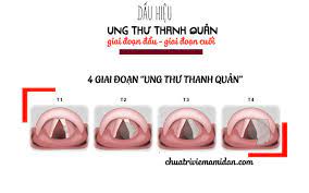 Trong ung thư thanh quản hạ họng, hóa chất chủ yếu được chỉ định phối hợp đồng thời với xạ trị nhằm mục đích tăng mức độ nhậy cảm của. Cac Giai Ä'oáº¡n Cá»§a Ung ThÆ° Thanh Quáº£n