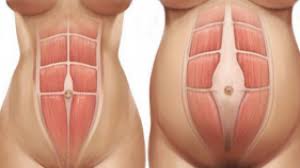 Higher in schedule and content exercise underweight. Diastasis Recti Abdominis Abdominal Separation Post Pregnancy