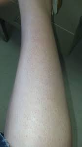 I Found This Helpful Answer From A Dermatologist On Justanswer Com Red Hair Beauty Pore