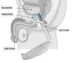 นวดกษัย นวดต่อมลูกหมาก #prostatemassage สนใจ:082 265 4936 line : Sonic Prostate Massager Best Prostate Vibrator By Prostate Health Center