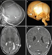 Imaging Of Cerebrospinal Fluid Shunts Drains And Diversion Techniques Radiology Key
