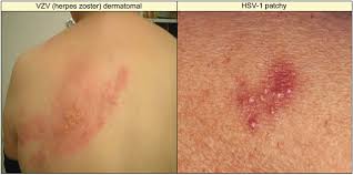 Symptoms typically start with pain along the affected. The Challenging Patient With Varicella Zoster Virus Disease Neurology Clinical Practice