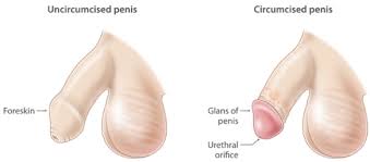 Image result for Neonatal Circumcision