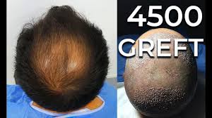4500 Greft Fue Method Vatanmed Sakal Sac Ordu