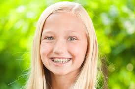 Rubber bands for braces are also known as elastics. What Are Those Rubber Bands On Braces Summit Family Orthodontics