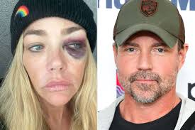 Why Denise Richards Stepped Out with Black Eye (Exclusive Source)
