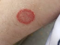 Image result for Skin Infection