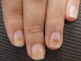 Doxycycline Dapsone Photosensitivity In 2021 Common Medications Skin Photo Nsaids