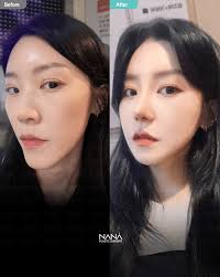 ✨【輪郭整形・両顎手術を受けた方必見！“NANAプレミアム自家血幹細胞ピン除去”とは？最適なタイミング＆メリットを解説】｜韓国整形NANA美容外科