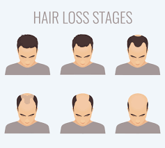 Male Pattern Baldness Vegas Valley Hair Restoration