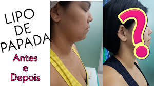 Lipo Papada Precio