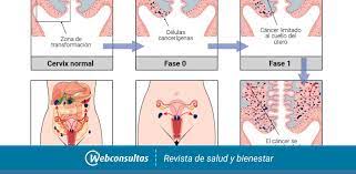 Assim, além de se saber quais os sintomas do câncer de colo do útero. Clasificacion Y Pronostico Del Cancer De Cuello De Utero