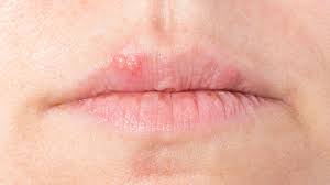 Ein pickel an der lippe kann sehr ärgerlich sein, zumal es auch eine sehr ungünstige stelle ist. Herpes An Lippen Oder Nase Richtig Behandeln Ndr De Ratgeber Gesundheit
