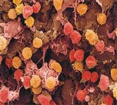 Nodüler skleroz, mikst sellüler tip, lenfositin çok olduğu ve lenfositen fakir tip olmak üzere ayrılırlar. Lenfoma Tedavisi Dogru Taniyla Sekilleniyor Saglik Haberleri Ntv