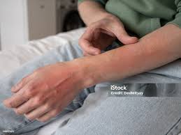 Image result for Neurotic Excoriation