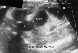 Ovarian cyst pelvic ultrasound female. Dedicated To The Mission Of Bringing Free Or Low Cost Educational Materials And Information To The Global Ultrasound Community