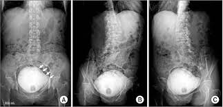 Image result for Voiding Cystourethrogram