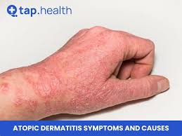 Image result for Atopic eczema atopic dermatitis